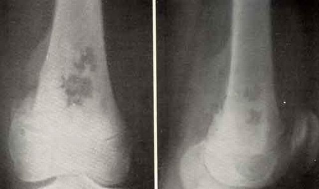 Остеосаркома колена поражает костные ткани и характеризуется интенсивным ростом.