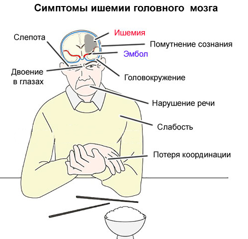 Ишемия головного мозга в пожилом возрасте симптомы и лечение