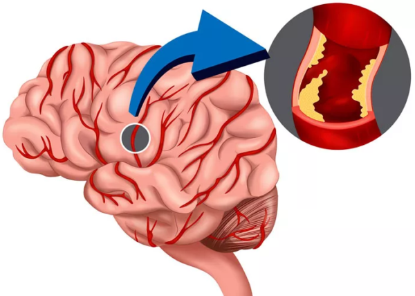 Ишемия головного мозга в пожилом возрасте симптомы и лечение