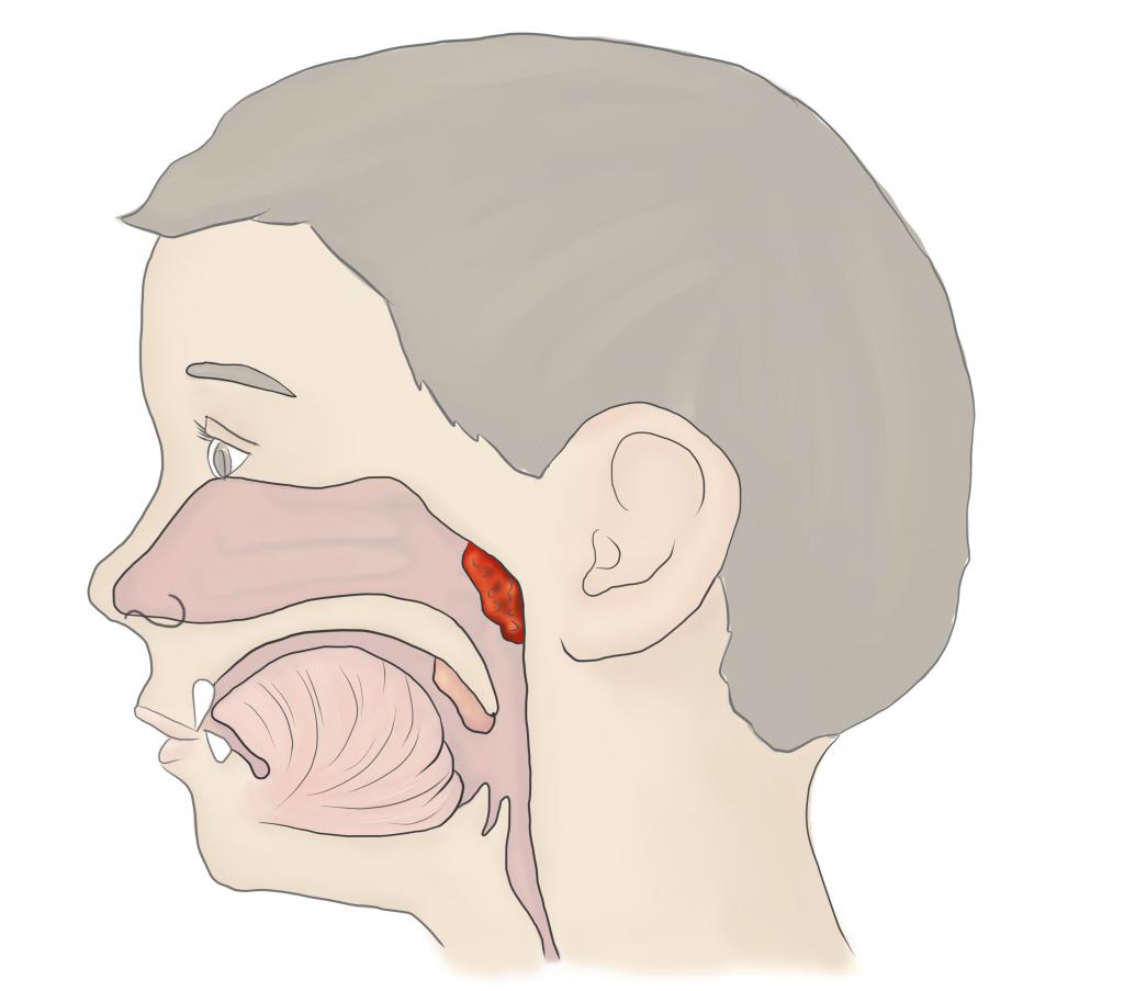 Заложило нос горло болит голова. Аденоиды носоглоточные миндалины. Носоглотка воспаление аденоиды. Анатомия носоглотки аденоиды. Что такое аденоиды в носоглотке у ребенка.