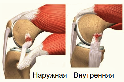 Разрывы коллатеральных связок колена
