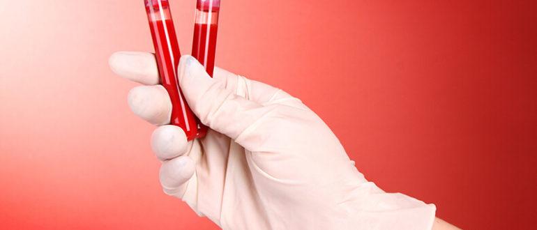 Что такое ВИЧ инфекция: ее характеристика, как проявляется и методы лечения
