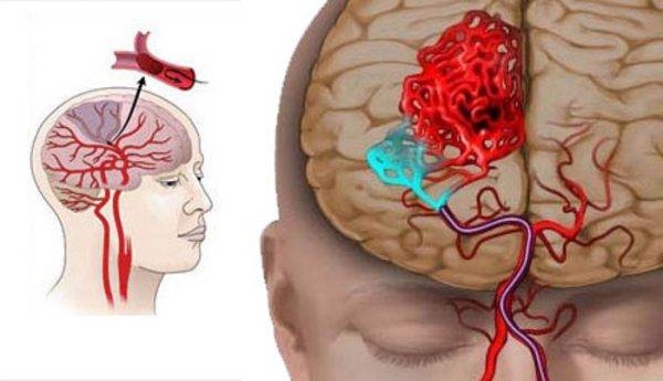 Атеросклероз сосудов головного мозга симптомы и лечение у пожилых людей