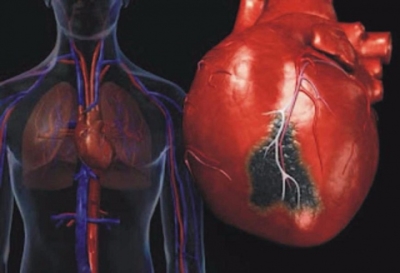 Как проявляется инфаркт? Его разновидности и причины наступления смерти