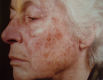 Разновидности старческих пигментных пятен на коже. Причины появления и способы их устранения