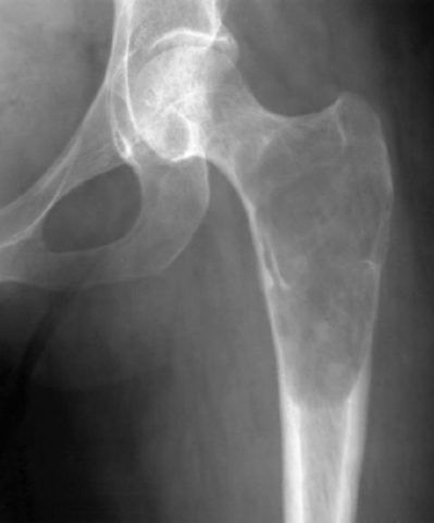 Активно – кистозная форма остеобластокластомы межвертельной области бедренной кости на рентгенологическом снимке.