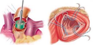 Гипертрофия миокарда левого желудочка сердца