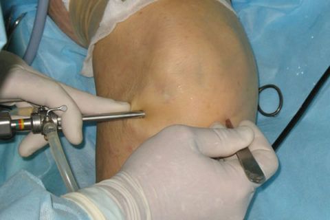 Артроскопия – малоинвазивная операция без вскрытия сустава