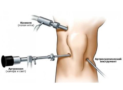 Артроскопия — малоинвазивное вмешательство