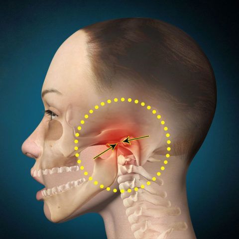 Артроз челюстного сустава приводит к нарушению движений челюсти