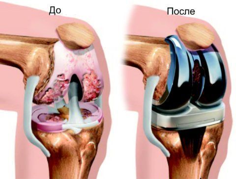 Артроз коленного сустава 3 степени — показание для хирургического вмешательства
