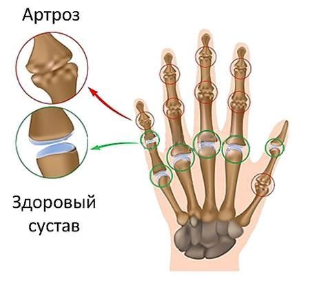 Артроз межфаланговых суставов рук чаще всего возникает у женщин.