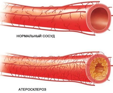 Бляшки приводят к сужению артерий