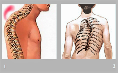 Боль и ущемление нерва на уровне груди также вызывают кифоз (1), сколиоз (2)
