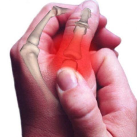 Боль при артрите развивается при нажатии на воспалённый сустав и в покое.