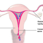 Болезненная менструация