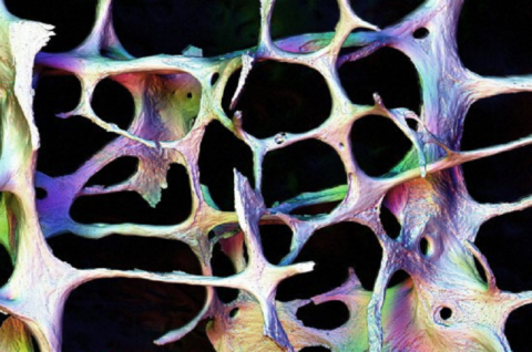 Человеческая костная ткань, поражённая остеопорозом (фото Колина Салтера)