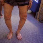 Деформированные суставы (как на фото) при ходьбе могут «щелкать»