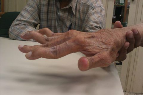 Деформированные суставы пальцев