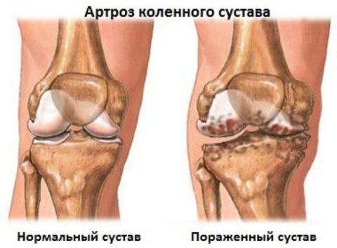 Деформирующие артроз коленного сустава