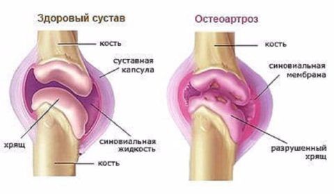 Деформирующий остеоартроз колена развивается чаще в пожилом возрасте у женщин.