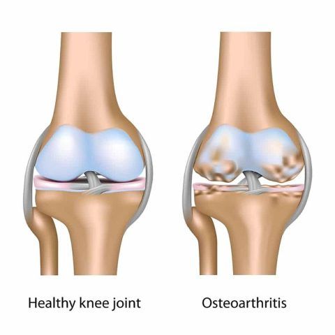 Деформирующий остеоартроз коленей поражает преимущественно женщин.