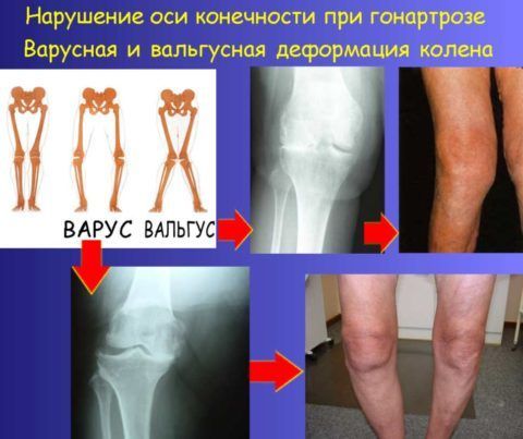 Деформирующий остеоартроз коленных суставов приводит к искривлению нижних конечностей.