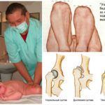Дисплазия тазовых соединений у грудничков – распространенная причина щелчков при движении нижними конечностями.