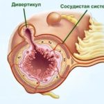 Дивертикулез кишечника