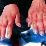 Длительное переохлаждение рук может привести не только к отморожению, но и формированию наростов