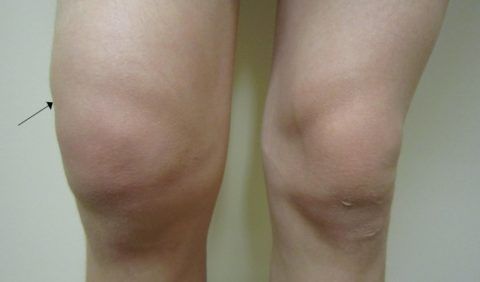 Для онкологии колена характерны изменения формы сочленения и его болезненность.
