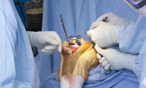 Эндопротезирование осуществляют специально обученные хирурги