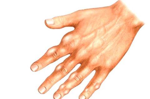 Если кистозные образования поражают пальцы рук, то могут значительно затруднять мелкую моторику.