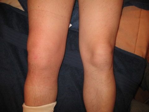 Если в области колена образовалось уплотнение, то можно заподозрить такое заболевание, как остеома.
