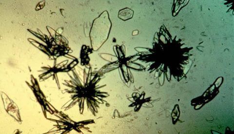 Фото кристаллов мочевой кислоты под микроскопом