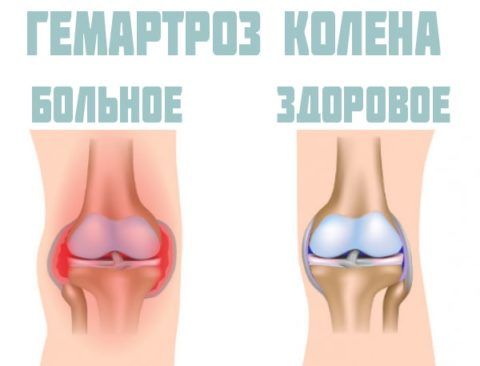 Гемартроз сустава (справа на картинке) – одно из возможных осложнений