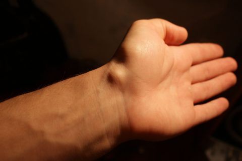 Гигрома на руке: фото сделано перед операцией
