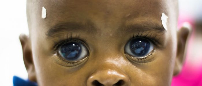 Глаукома у ребенка