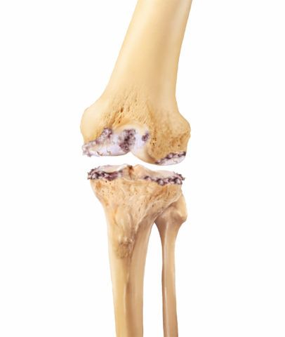 Гонартроз коленного сустава может привести к полному разрушению хряща
