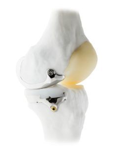 Успешные клинические исследования Unicompartmental Knee System от канадской компании Bodycad