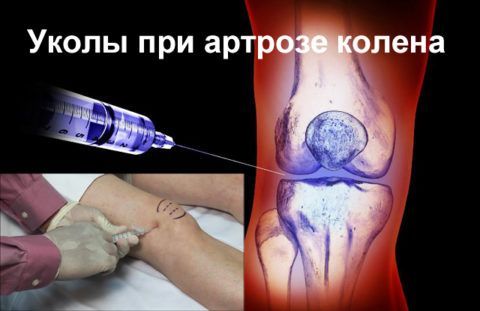 Инъекции при артрозе в колена приносят быстрый и действенный результат.