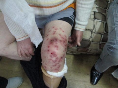 Инфекционный артрит коленного сустава. Пациенту оказывают помощь в отделении стационара. Заболевание в запущенной форме.