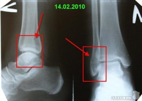 Интенсивность болезненности при травме ноги (голеностопа) зависит от размера повреждения костных тканей.