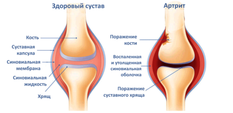 Изменение коленного сустава при ревматизме