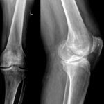 Изменение суставной ткани колена на рентгенологическом снимке.
