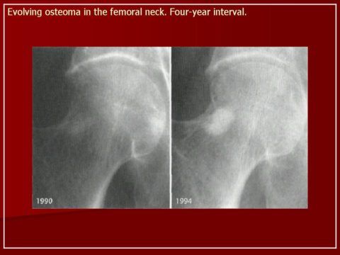 Изменения в остеоме тазобедренного сустава за 4 года.