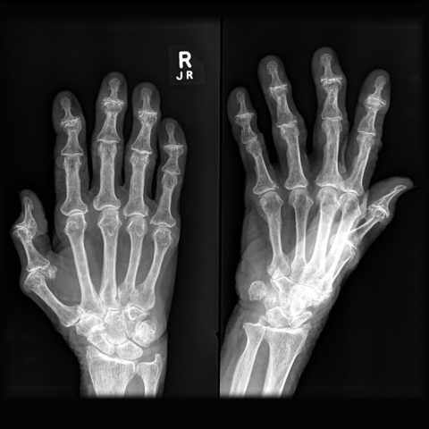 Изменения в суставах пальцев на рентгенограмме