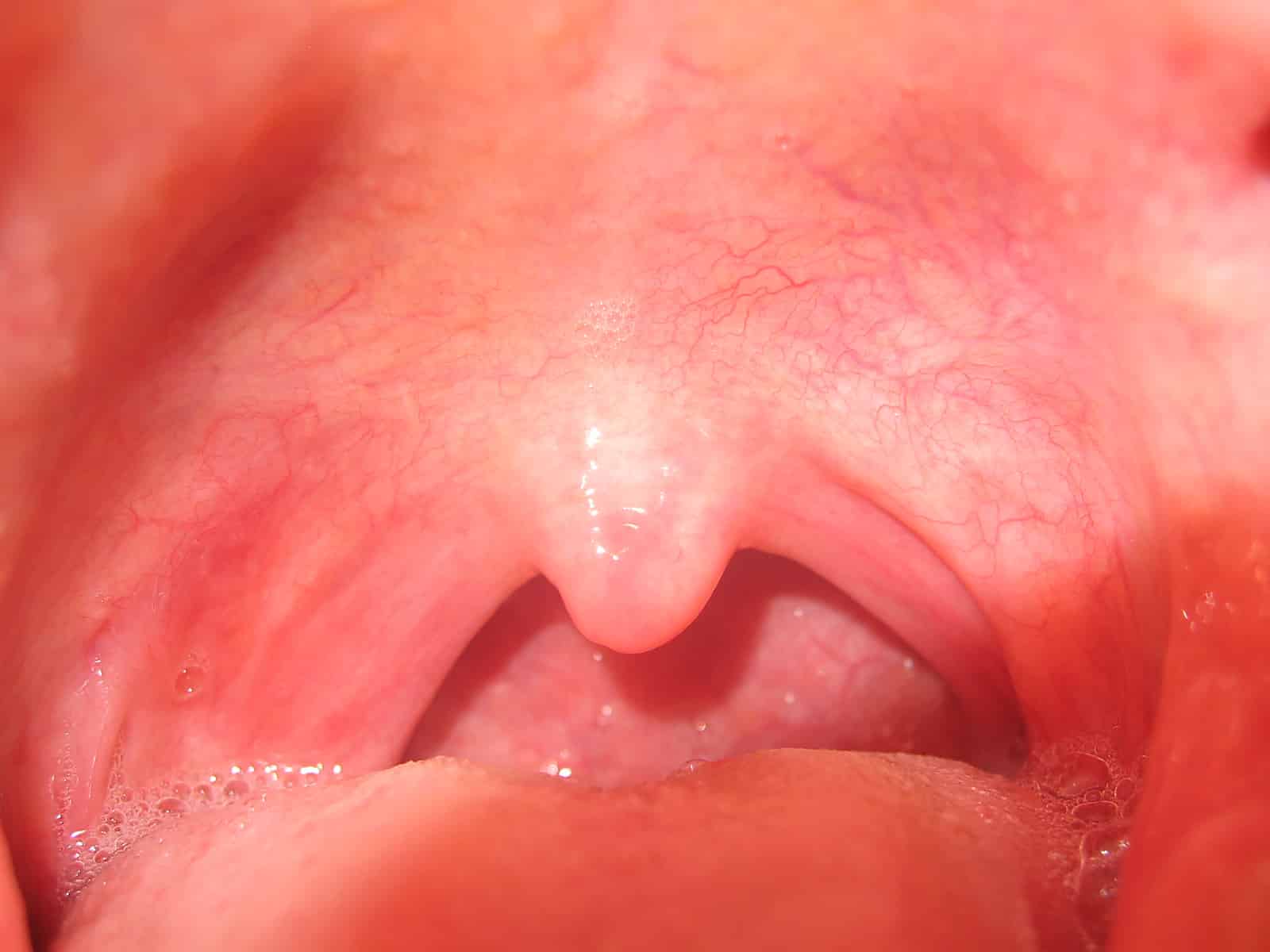 Здоровые миндалины в горле: как выглядят?