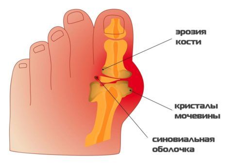 Классическая локализация подагрического артрита — большой палец ноги