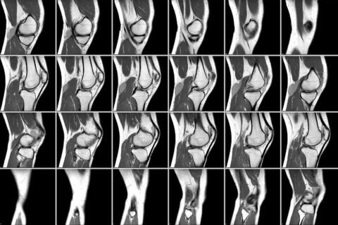 Компьютерная томография позволяет всесторонне оценить состояние сустава